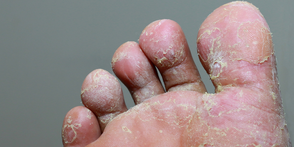 What is the best treatment for fungal infection