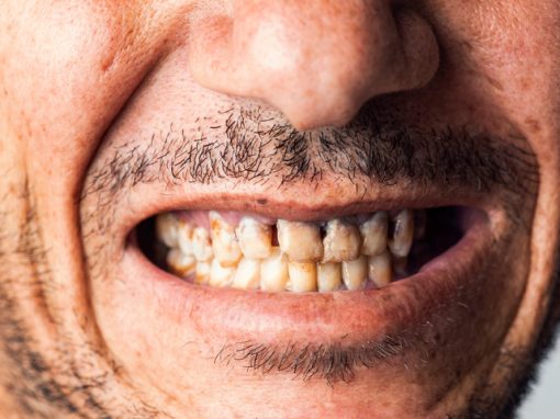 Can having bad teeth affect your overall health?