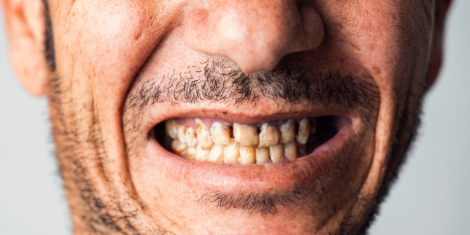 Can having bad teeth affect your overall health?